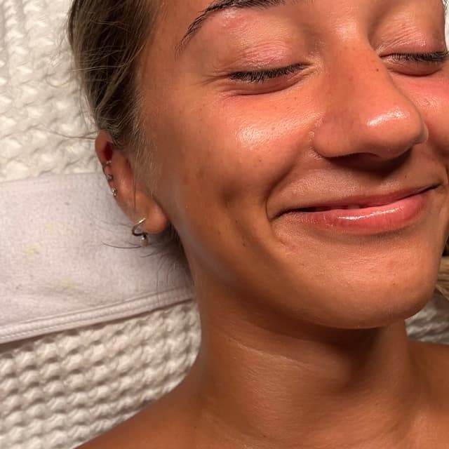 Peel Package at Naturally Esthetics in Myrtle Beach, SC